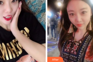 東莞康華醫(yī)院整形美容中心殷安柱整形價(jià)格表附光子嫩膚案例展示