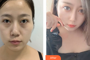 東莞主山愛康門診部醫(yī)學(xué)整形美容中心廖旭峰整形價(jià)格表附激光去眼袋案例展示