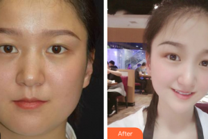 東莞韓美整形醫(yī)院廖星高整形價(jià)格表附射頻溶脂瘦臉案例展示