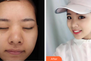 東莞締美整形美容醫(yī)院Dr.MichaelHGold整形價(jià)格表附白瓷光美白案例展示