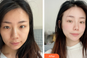 東莞瑞芙臣醫(yī)療美容門診部Mainguy整形價(jià)格表附埋線提升案例展示