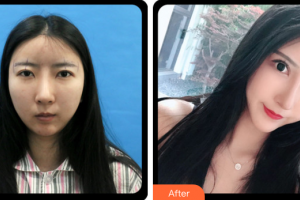 東莞瑞芙臣醫(yī)療美容門診部JianFarhadi整形價(jià)格表附眼部綜合案例展示