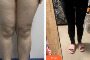 東莞瑞芙臣醫(yī)療美容門診部樸太赫整形價(jià)格表附全身吸脂案例展示