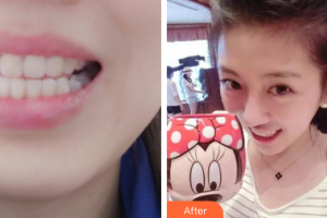 東莞美立方美容醫(yī)院曹德華整形價(jià)格表附隱形矯正案例展示