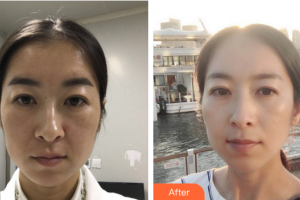 東莞瑞芙臣醫(yī)療美容門診部Christine整形價(jià)格表附熱瑪吉案例展示