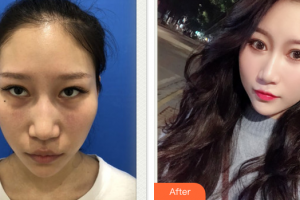 東莞瑞芙臣醫(yī)療美容門診部王貴賢整形價格表附激光去眼袋案例展示