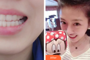 東莞華美醫(yī)療美容醫(yī)院熊科明整形價格表附隱形矯正案例展示