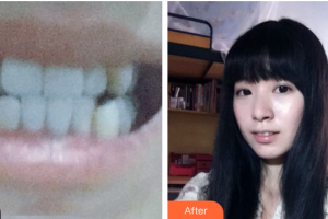 東莞華美醫(yī)療美容醫(yī)院戴俊民整形價格表附金屬矯正案例展示