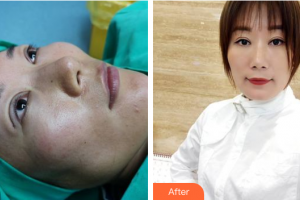 東莞百佳瑪麗亞婦產(chǎn)醫(yī)院陳銘整形價格表附雙眼皮案例展示