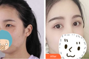 東莞華美醫(yī)療美容醫(yī)院李佳輝整形價格表附眼部手術(shù)案例展示