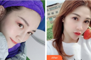 東莞韓美整形醫(yī)院劉小婷整形價格表附水光補(bǔ)水案例展示