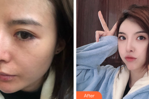 東莞寶格麗醫(yī)療美容門診部吳波整形價格表附埋線提升案例展示