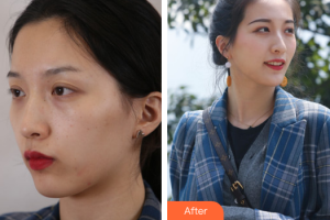 東莞市第六人民醫(yī)院醫(yī)療美容中心袁鐘岱整形價格表附超激光美膚嫩膚案例展示