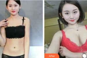 東莞市第六人民醫(yī)院醫(yī)療美容中心顏小武整形價格表附自體脂肪豐胸案例展示