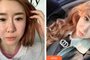 東莞仁康醫(yī)院整形美容中心郭靜蘋整形價格表附埋線提升案例展示