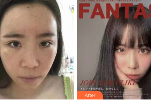 東莞美立方美容醫(yī)院張克整形價格表附切開重瞼+內(nèi)眥贅皮矯正案例展示