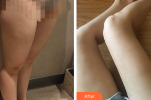 東莞同濟(jì)光華醫(yī)院口腔科郭愛華整形價格表附大腿吸脂案例展示