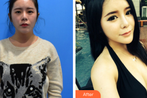 東莞同濟(jì)光華醫(yī)院口腔科戴新明整形價格表附自體脂肪隆胸案例展示