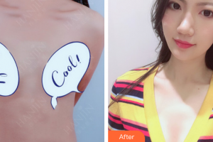 東莞非凡美容醫(yī)院易培金整形價格表附假體隆胸案例展示