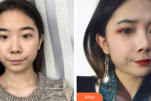 河南整形美容醫(yī)院尹趙心整形價格表附皮膚美容案例展示