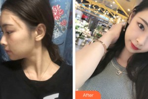 河南大學(xué)附屬南石醫(yī)院燒傷整形美容中心楊洪整形價格表附皮膚美容案例展示