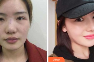 河南大學(xué)附屬南石醫(yī)院燒傷整形美容中心楊丙厚整形價格表附隆鼻手術(shù)案例展示