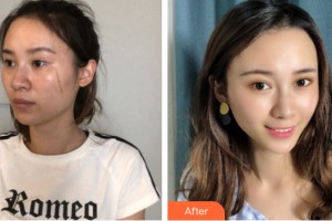 河南大學(xué)附屬南石醫(yī)院燒傷整形美容中心趙俊芳整形價格表附皮膚美容案例展示