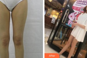 河南協(xié)和醫(yī)院整形外科翟紹旭整形價格表附大腿吸脂案例展示