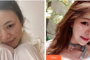 河南省現(xiàn)代醫(yī)學(xué)研究院中醫(yī)院七星整形美容中心劉亞輝整形價格表附皮膚美容案例展示