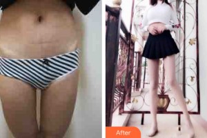 河南科技大學(xué)第一附屬醫(yī)院整形美容科徐興軍整形價格表附大腿吸脂案例展示