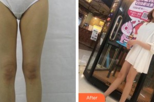 河南整形美容醫(yī)院劉乾坤整形價格表附大腿吸脂案例展示