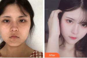 河南省整形美容研究中心湯芳芳整形價格表附皮膚美容案例展示