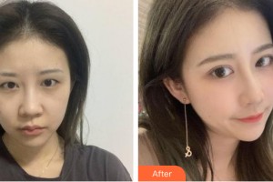 河南整形美容醫(yī)院張敏整形價格表附眼部手術(shù)案例展示