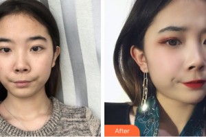 河南省煤炭總醫(yī)院激光整形中心張新華整形價格表附皮膚美容案例展示