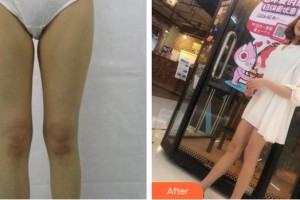 河南艾斯醫(yī)療美容醫(yī)院黃仲立整形價格表附大腿吸脂案例展示