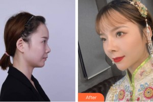 武警河南省總隊(duì)醫(yī)院激光整形中心解邦杰整形價格表附鼻部手術(shù)案例展示