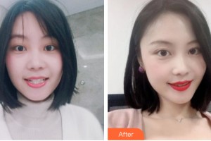 武警河南省總隊(duì)醫(yī)院激光整形中心劉紅整形價格表附牙齒矯正案例展示