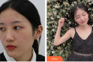 河南整形美容醫(yī)院尹彩霞整形價格表附皮膚美容案例展示