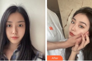 河南整形美容醫(yī)院張丹整形價格表附眼部手術(shù)案例展示