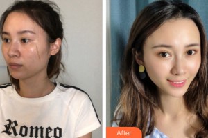 河南宏力醫(yī)院燒傷整形科張彬宇整形價格表附皮膚美容案例展示