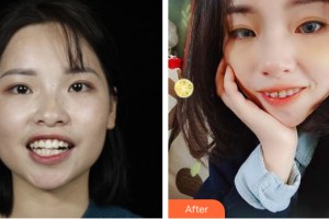 海南口腔醫(yī)院祖青整形價(jià)格表附牙齒矯正案例展示