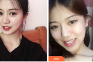 廣東醫(yī)學院附屬醫(yī)院整形外科羅少軍整形價格表附面部吸脂案例展示