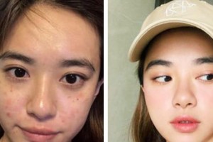 廣東藥學院附屬第一醫(yī)院激光整形美容外科楊曙整形價格表附激光祛斑案例展示