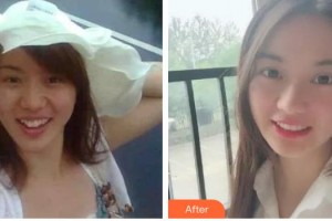 廣東藥科大學附屬第三醫(yī)院整形美容科黃羨整形價格表附金屬托槽矯正案例展示