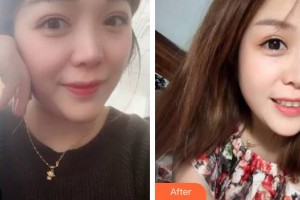 廣東藥科大學附屬第三醫(yī)院整形美容科馮澤宇整形價格表附牙齒隱形矯正案例展示