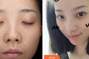 廣東藥科大學附屬第一醫(yī)院醫(yī)療美容科羅麗芳整形價格表附清潔祛痘案例展示