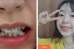 云南華美美萊美容醫(yī)院馮銳整形價格表附牙齒陶瓷矯正案例展示