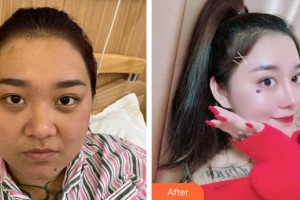 云南華美美萊美容醫(yī)院金永德整形價格表附鼻部綜合案例展示