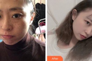 海南蘭顏慧醫(yī)學(xué)美容醫(yī)院羅文整形價(jià)格表附皮膚美容案例展示