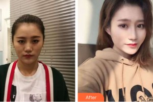 海南整形美容醫(yī)院劉永忠整形價(jià)格表附隆鼻手術(shù)案例展示